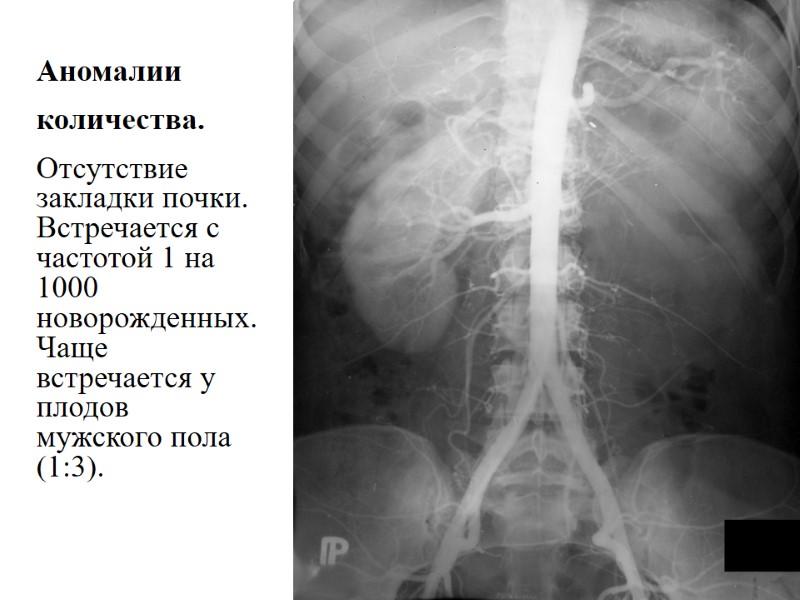 Аномалии  количества. Отсутствие закладки почки. Встречается с частотой 1 на 1000 новорожденных. Чаще